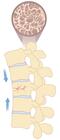 골다공증 척추 일러스트